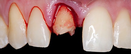 Extraction showing damaged tooth root