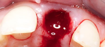 Immediate post-extraction socket view