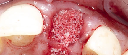 Socket preparation for grafting