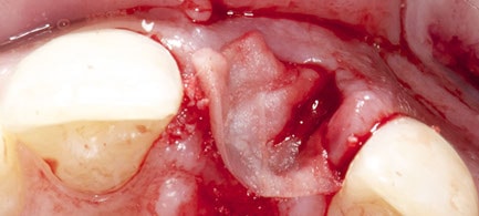 Initial soft tissue closure