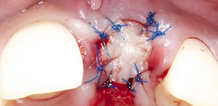 Soft tissue healing showing ridge contour