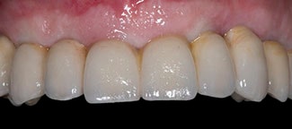 Ring flash dental photography example