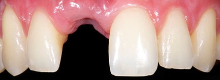 Final healed ridge ready for implant