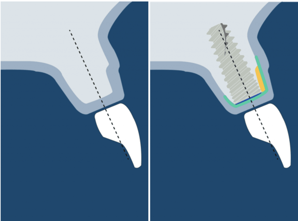 Guided bone regeneration in class 0 defect