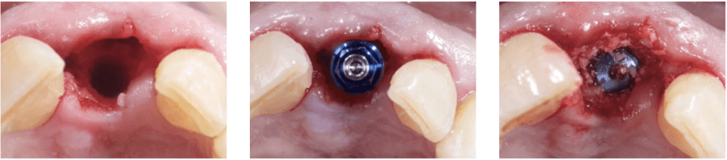 Guided bone regeneration in class 1 defect clinical picture