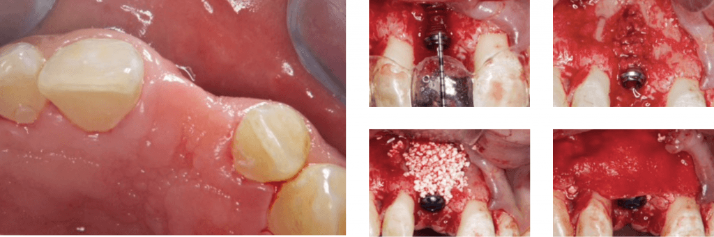 Guided bone regeneration in the aesthetic zone.