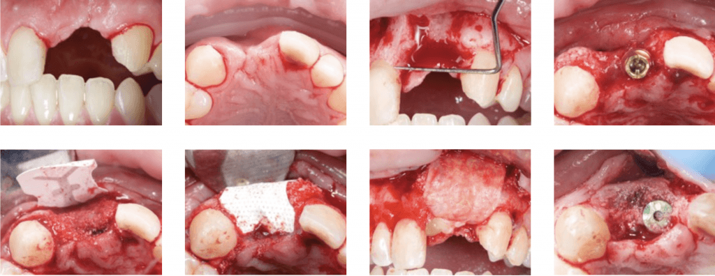 e-ptfe membranes in Suspended External-Internal Suture