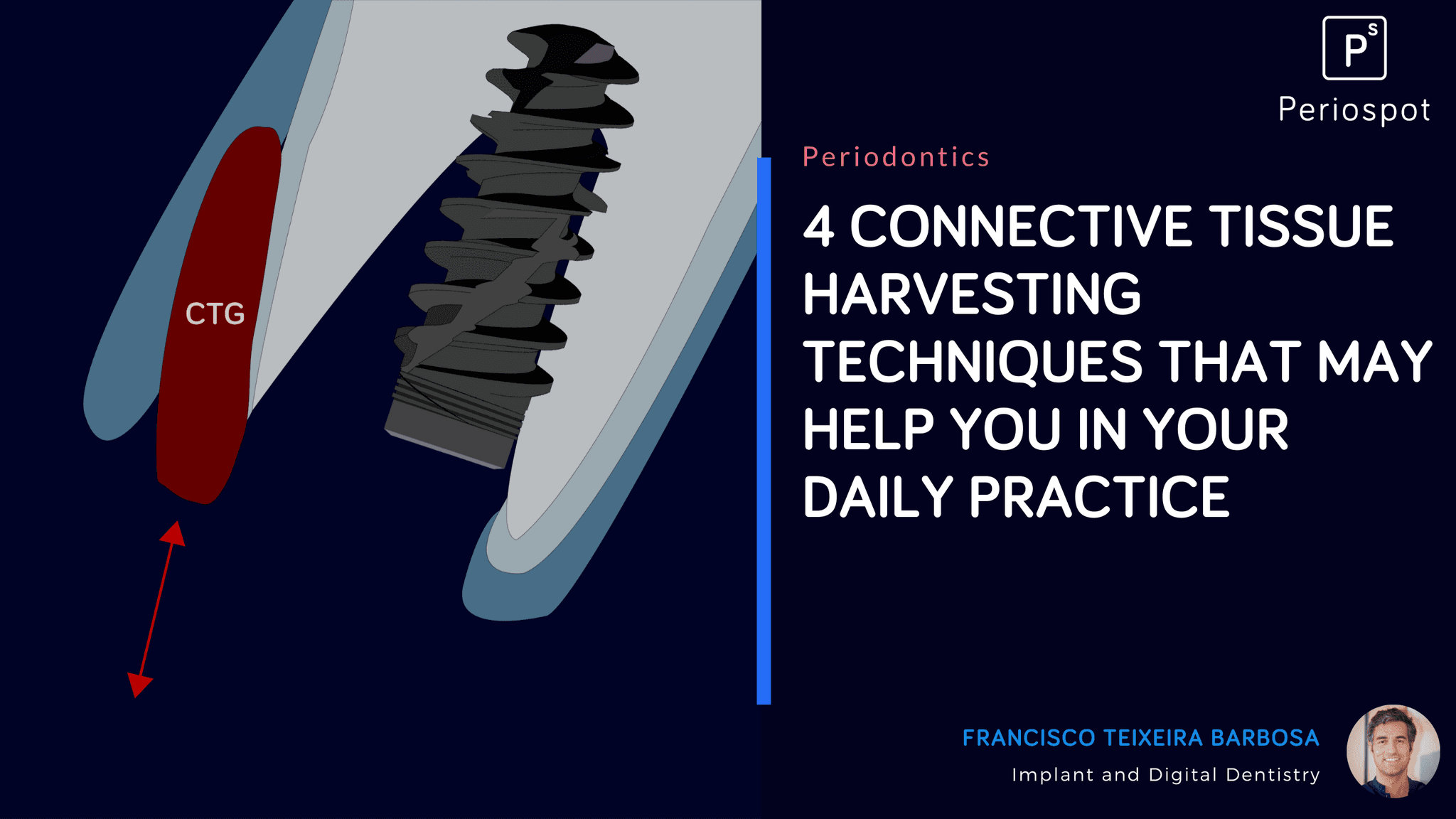4 connective tissue harvesting techniques that may help you in your daily practice