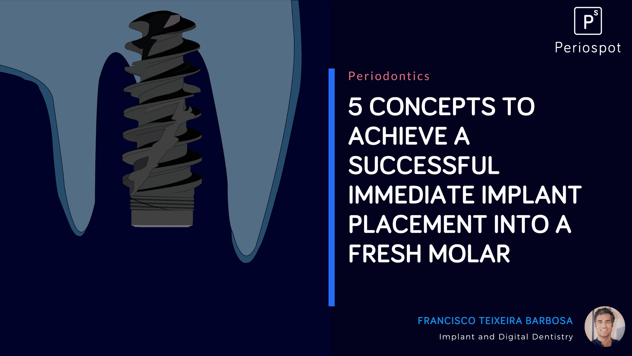 5 Concepts to Achieve a Successful Immediate Implant Placement Into a Fresh Molar