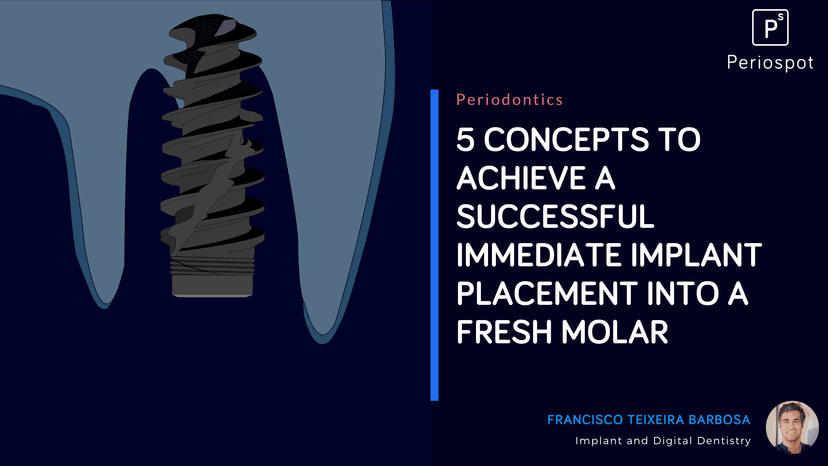 5 Concepts to Achieve a Successful Immediate Implant Placement Into a Fresh Molar