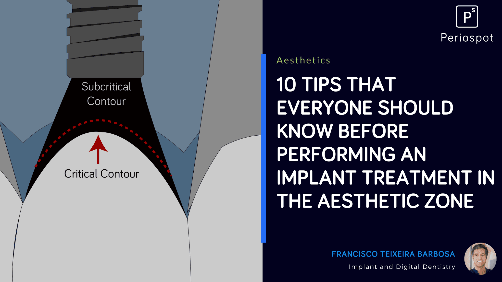10 Tips that Everyone Should Know Before Performing an Implant Treatment in the aesthetic zone
