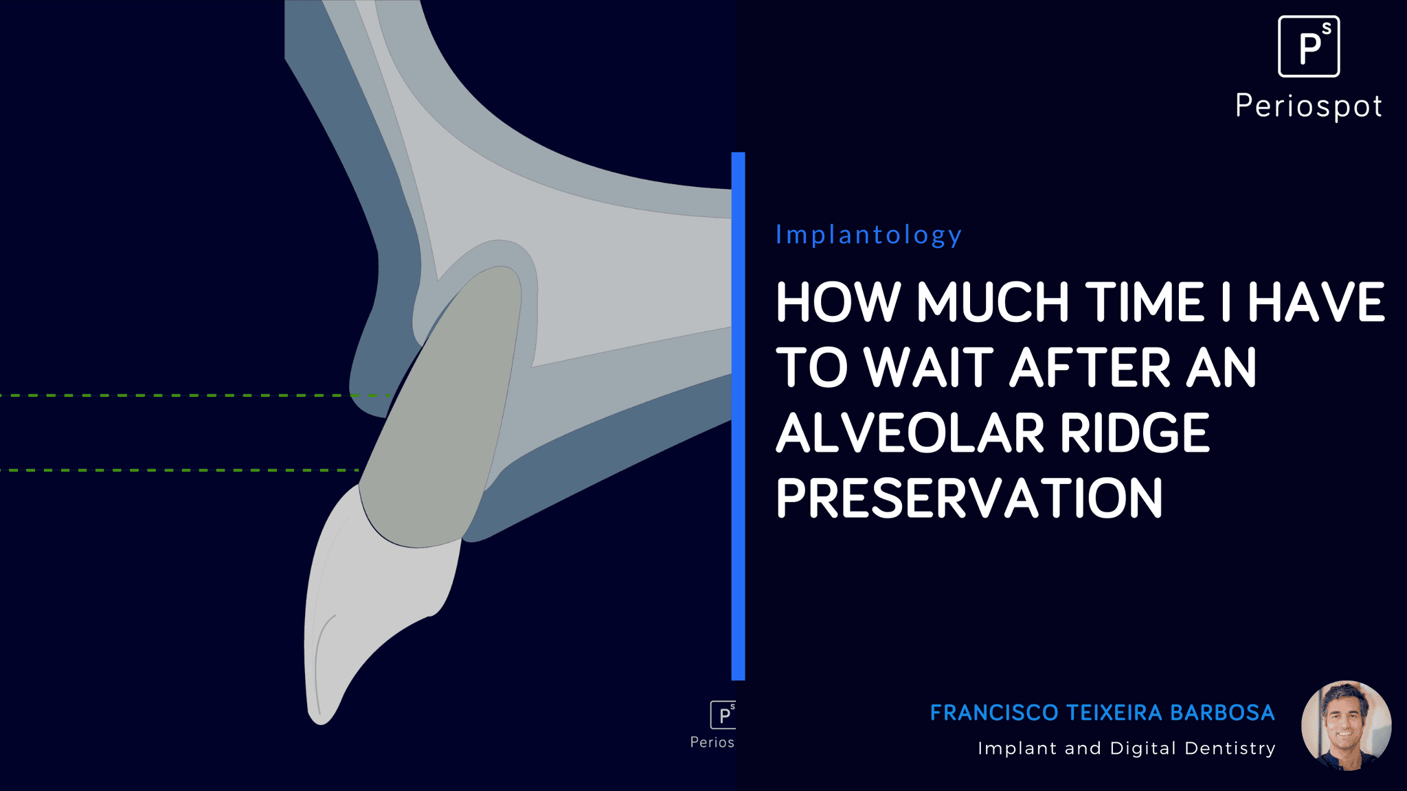 How much time I have to wait after an alveolar ridge preservation