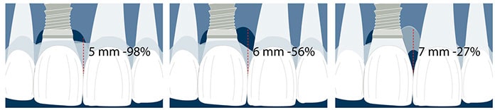 implants in the aesthetic zone and the height of the papilla