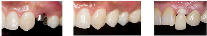 Implants in the aesthetic zone and the importance of choosing the correct abutment