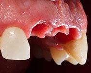 Provisional in implants in the aesthetic zone