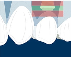 ideal position implants in the aesthetic zone