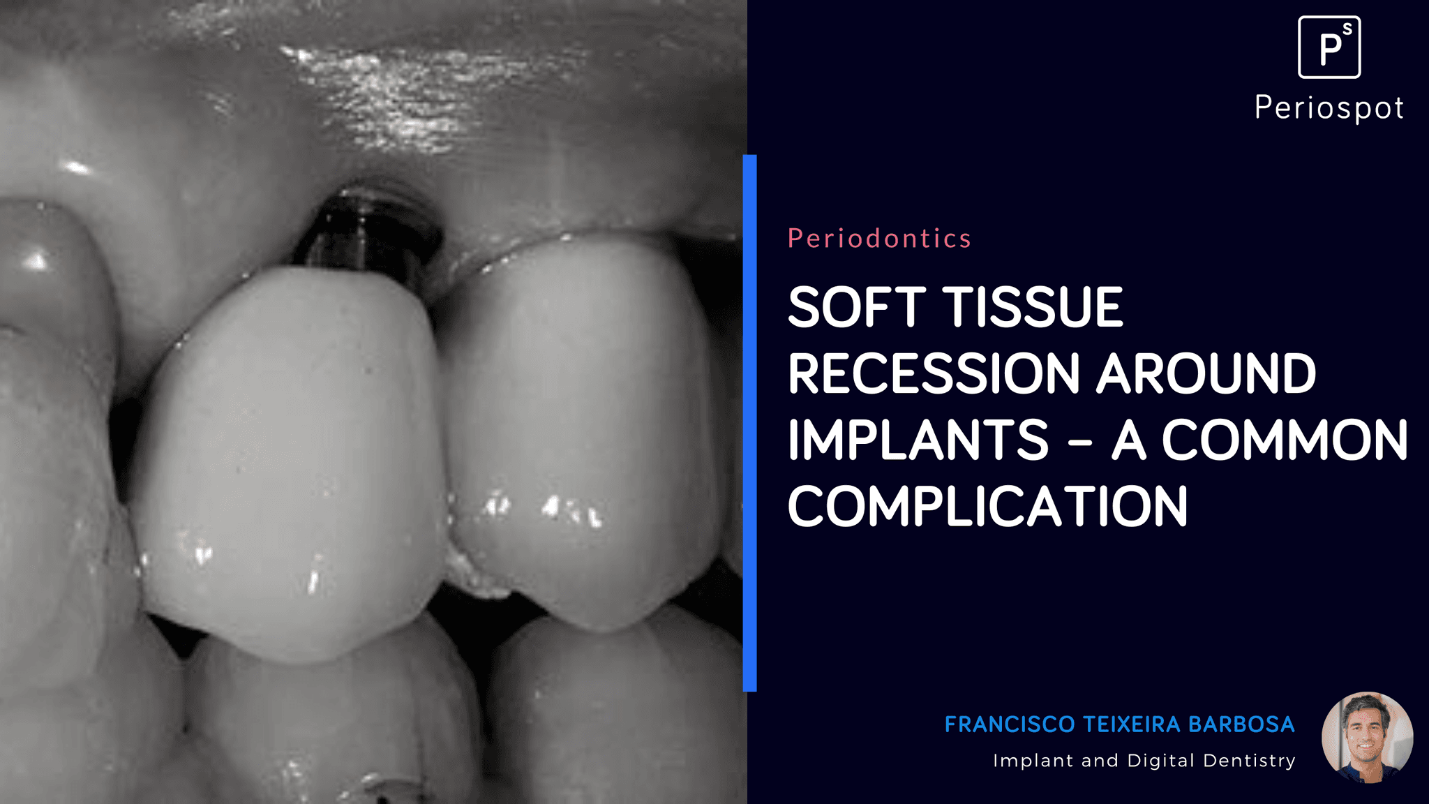 Soft Tissue Recession Around Implants – A common Complication