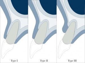 Elian Classification 2007 for socket preservation and also useful in immediate implants in the aesthetic zone.