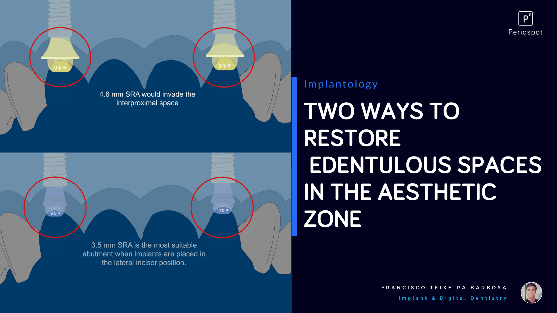 Two ways to Restore Edentulous Spaces in the Aesthetic Zone