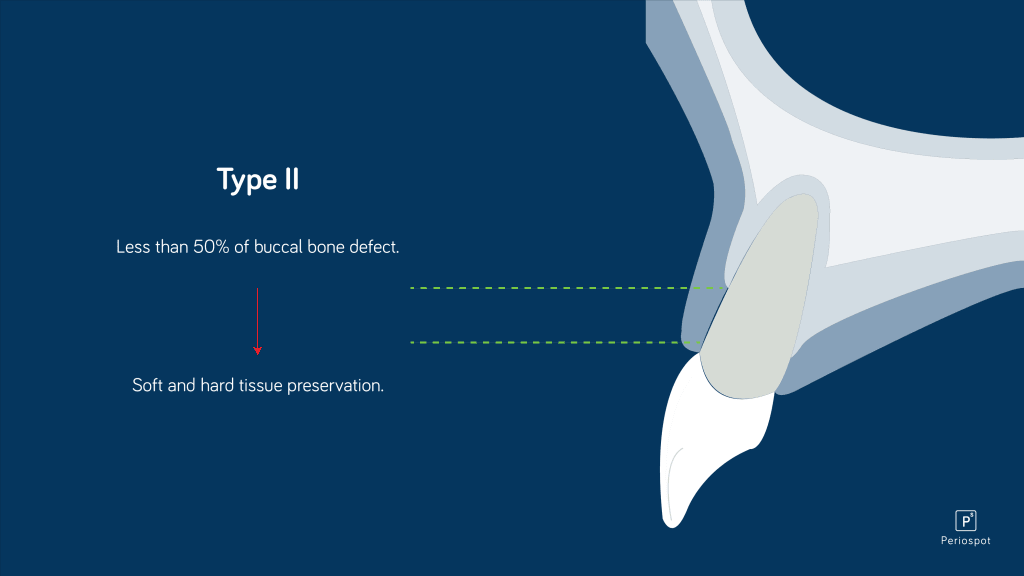 Alveolar ridge preservation with less than 50% of resorption