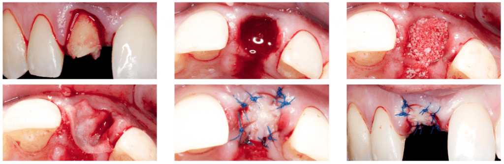 Alveolar ridge preservation using the Ice Cone technique