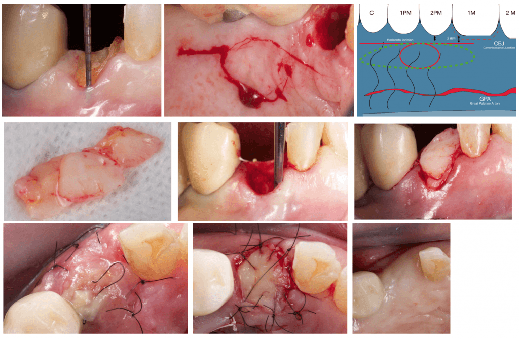 Alveolar ridge preservation using the stimmelmayer technique