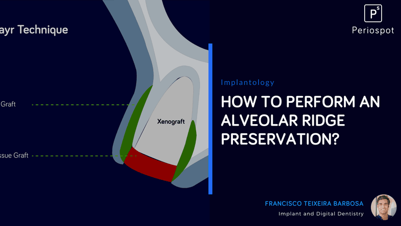 Alveolar Ridge Preservation: How to Perform Socket Preservation Techniques