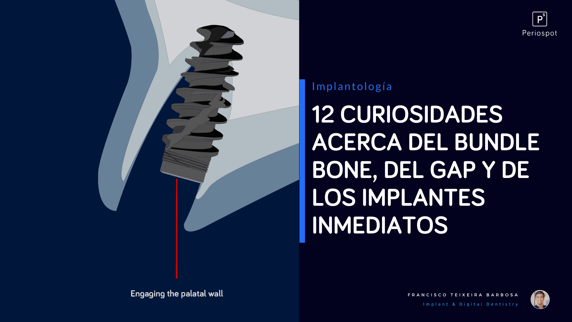 12 curiosidades acerca del Bundle Bone, del Gap y de los Implantes Inmediatos.