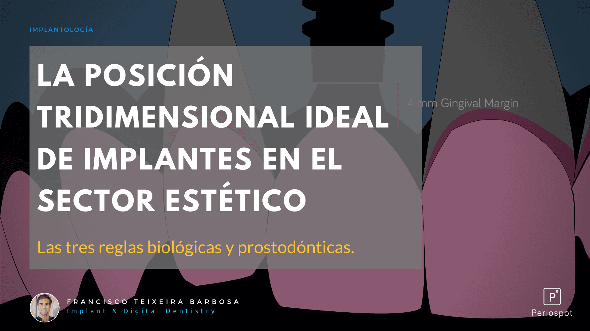 La Posición Tridimensional Ideal de Implantes en el Sector Estético.