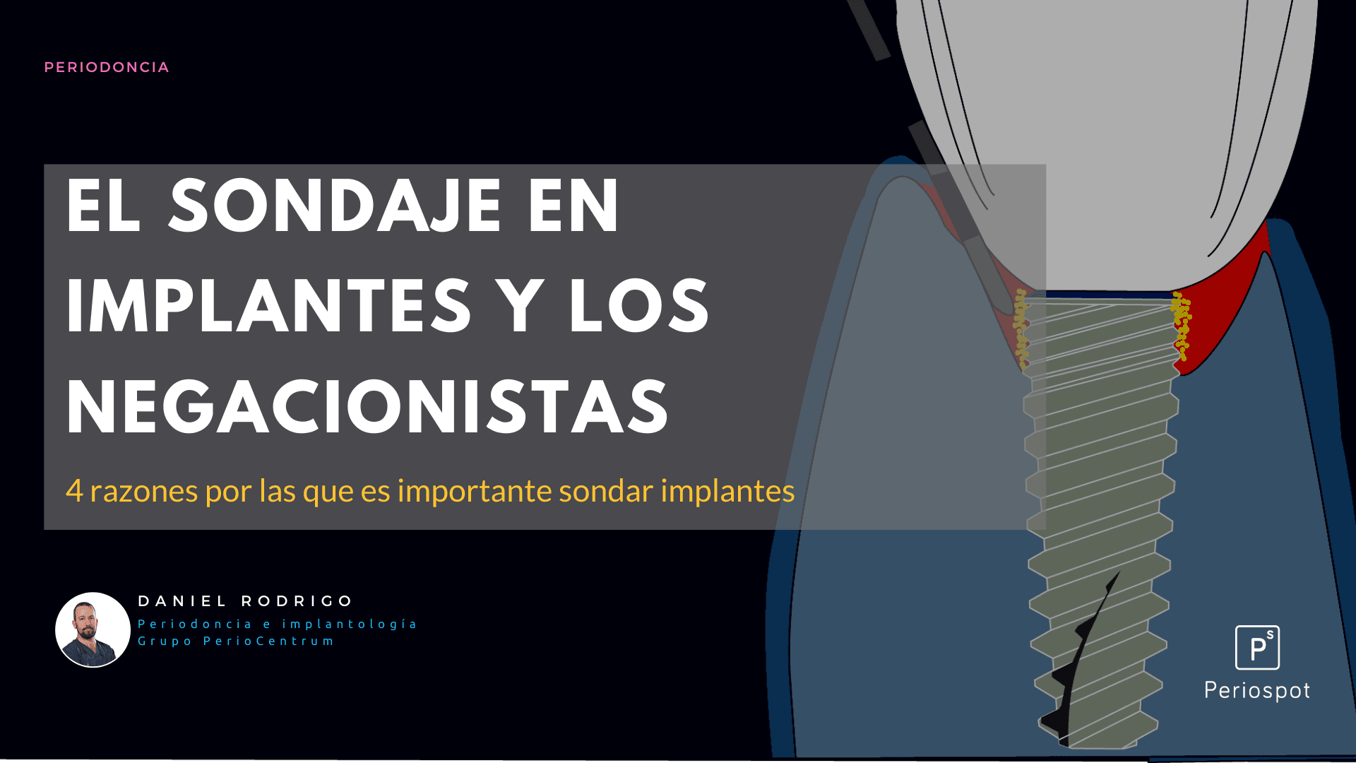 El sondaje en implantes y los negacionistas- 4 razones por las que es importante sondar implantes