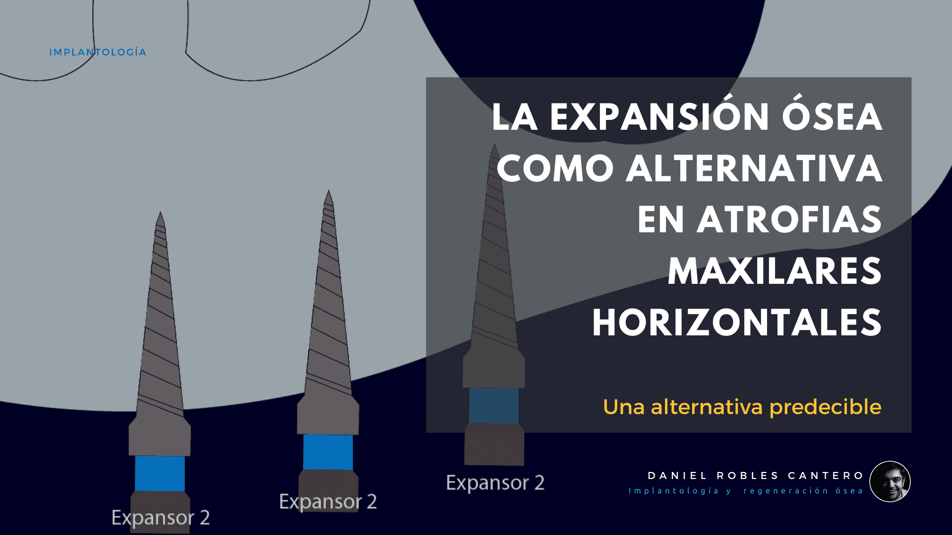 La Expansión Ósea como Alternativa en atrofias maxilares Horizontales