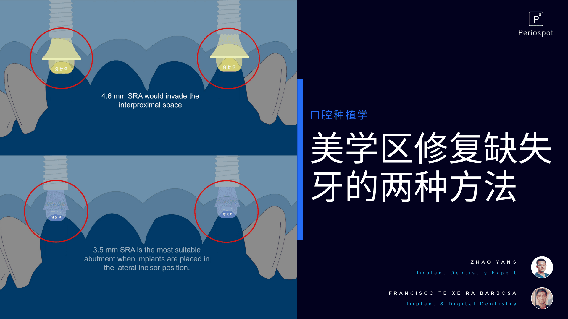 美学区修复缺失牙的两种方法