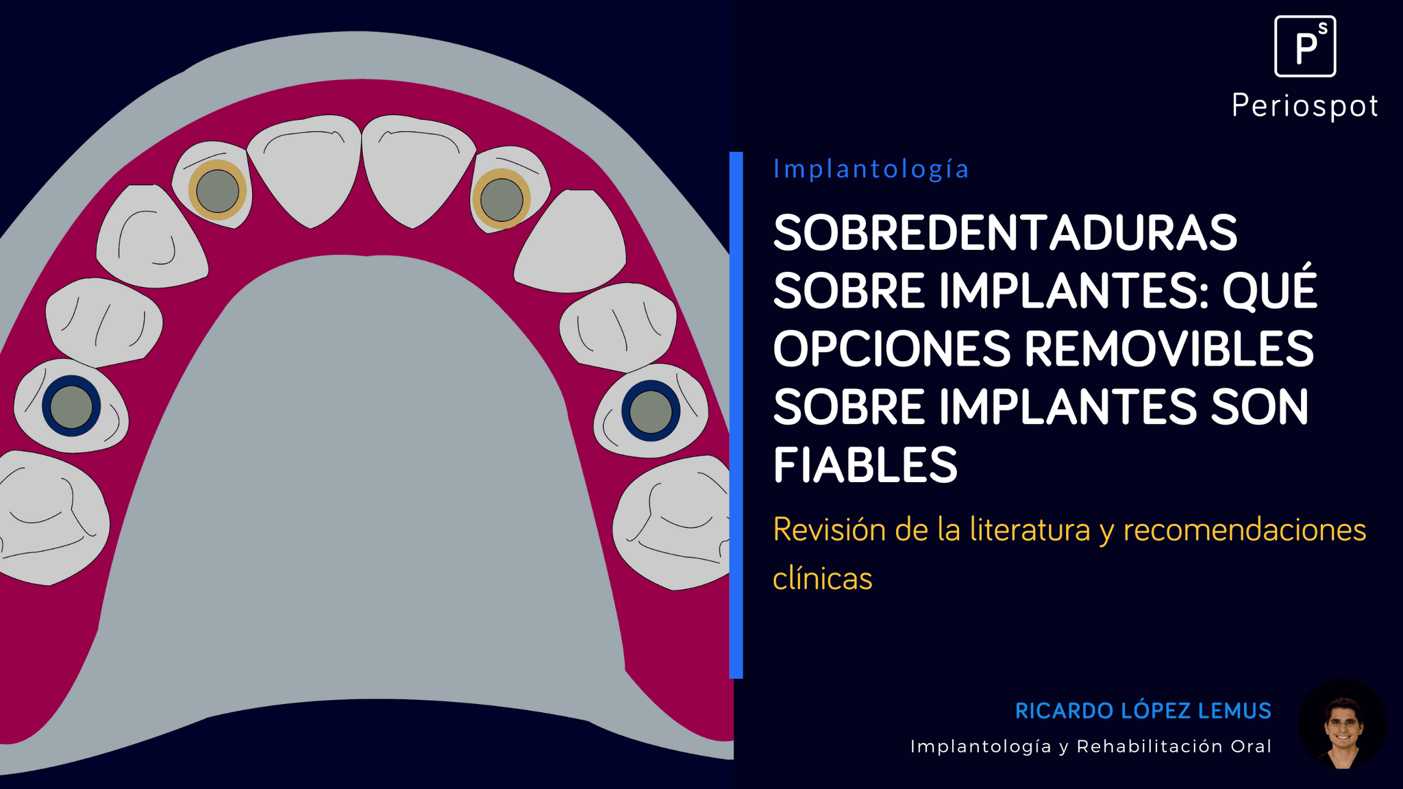 Sobredentaduras sobre Implantes: Qué opciones Removibles Sobre Implantes Son Fiables