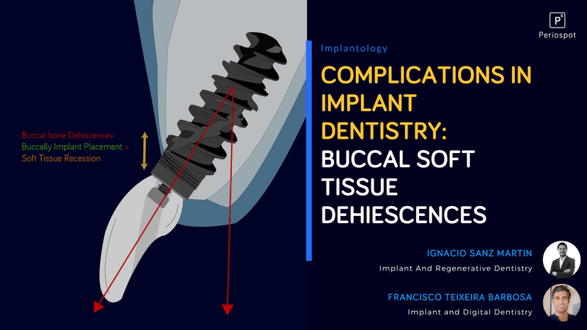 Complications in Dental Implant Dentistry: Buccal Soft Tissue Dehiscences