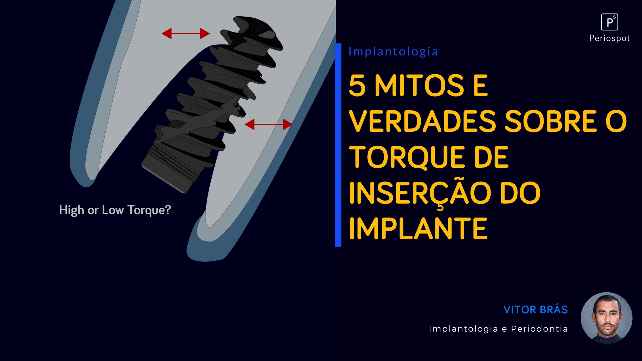 5 mitos e verdades sobre o torque de inserção do implante