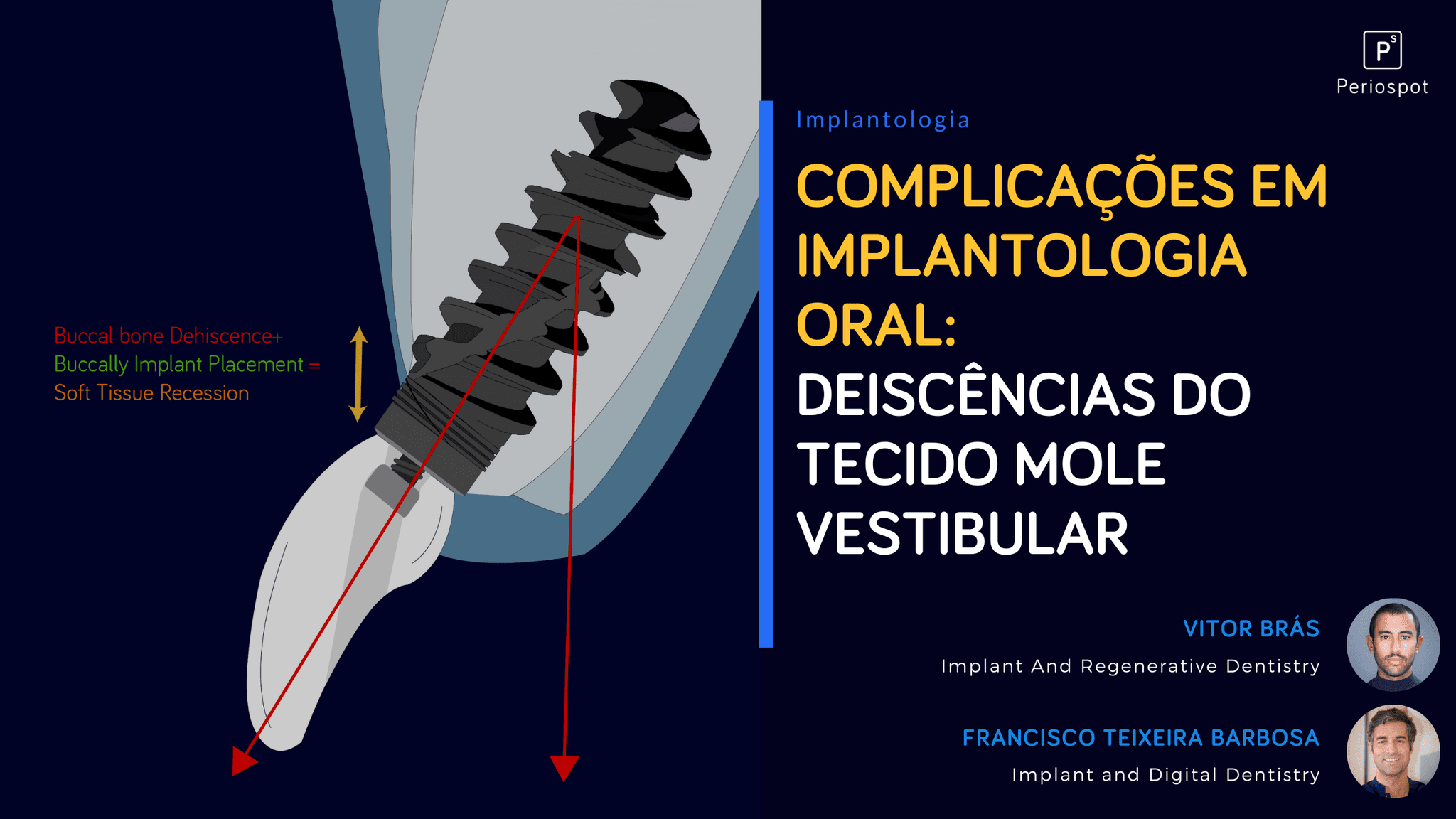 Complicações em Implantologia Oral: Deiscências do tecido mole vestibular