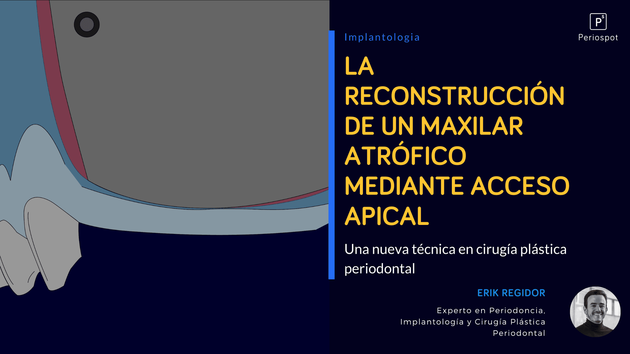 La Reconstrucción de un Maxilar Atrófico Mediante Acceso Apical