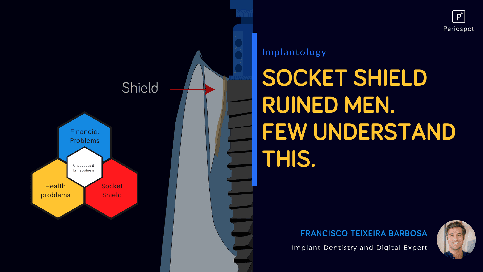 Socket Shield ruined men. Few understand this.