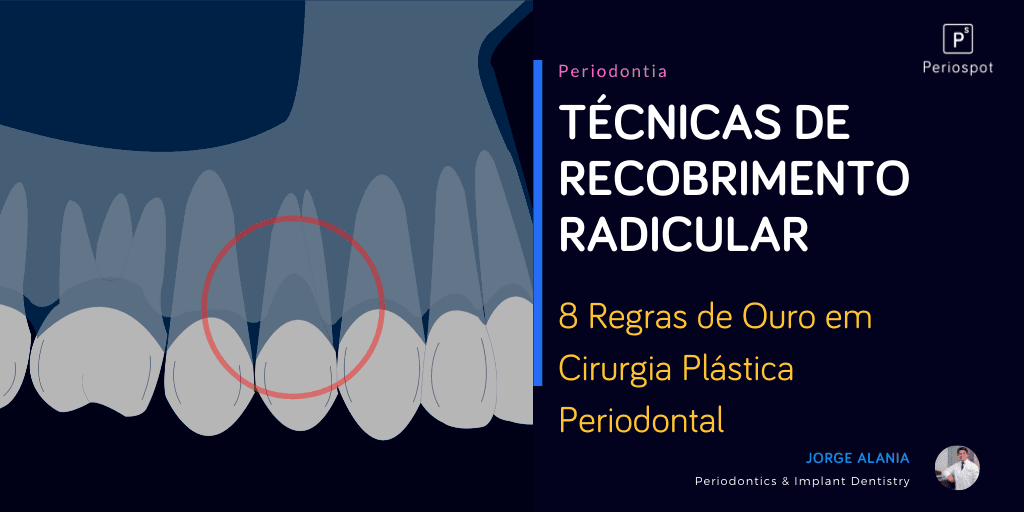 Técnicas de recobrimento radicular, a minha primeira vez! 8 Regras de Ouro em Cirurgia Plástica Periodontal