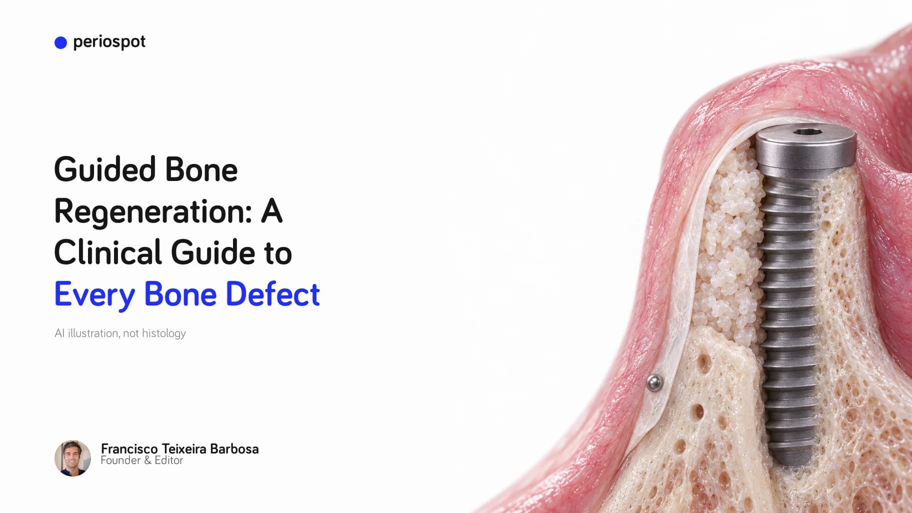 Guided Bone Regeneration: A Clinical Guide to Every Bone Defect (AI illustration)