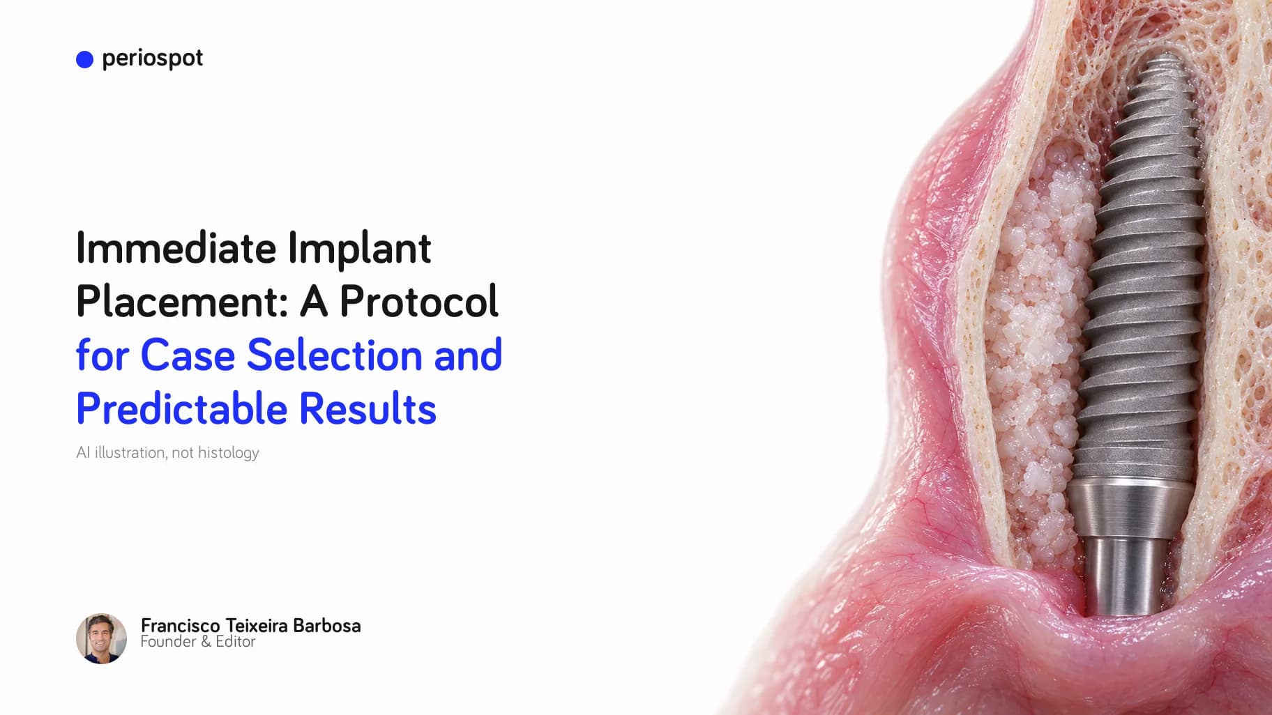 Immediate Implant Placement: A Protocol for Case Selection and Predictable Results (AI illustration)