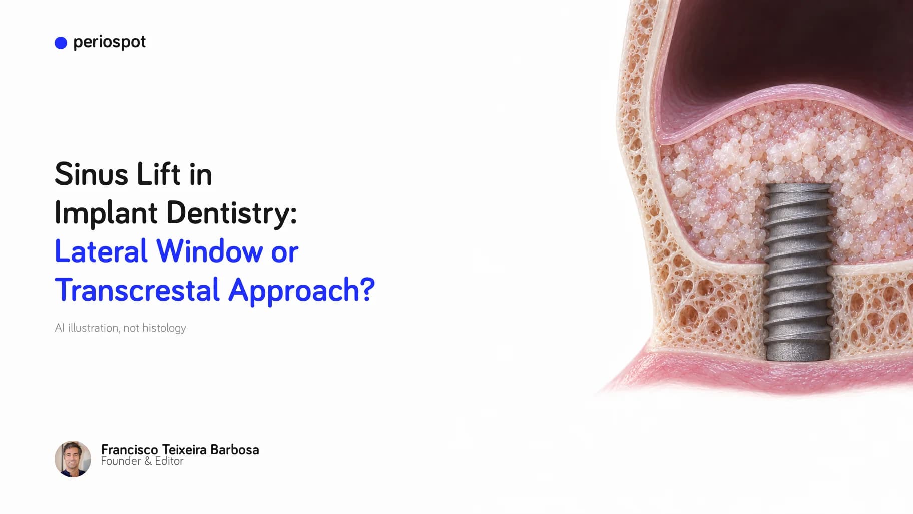 Sinus Lift in Implant Dentistry: Lateral Window or Transcrestal Approach? (AI illustration)