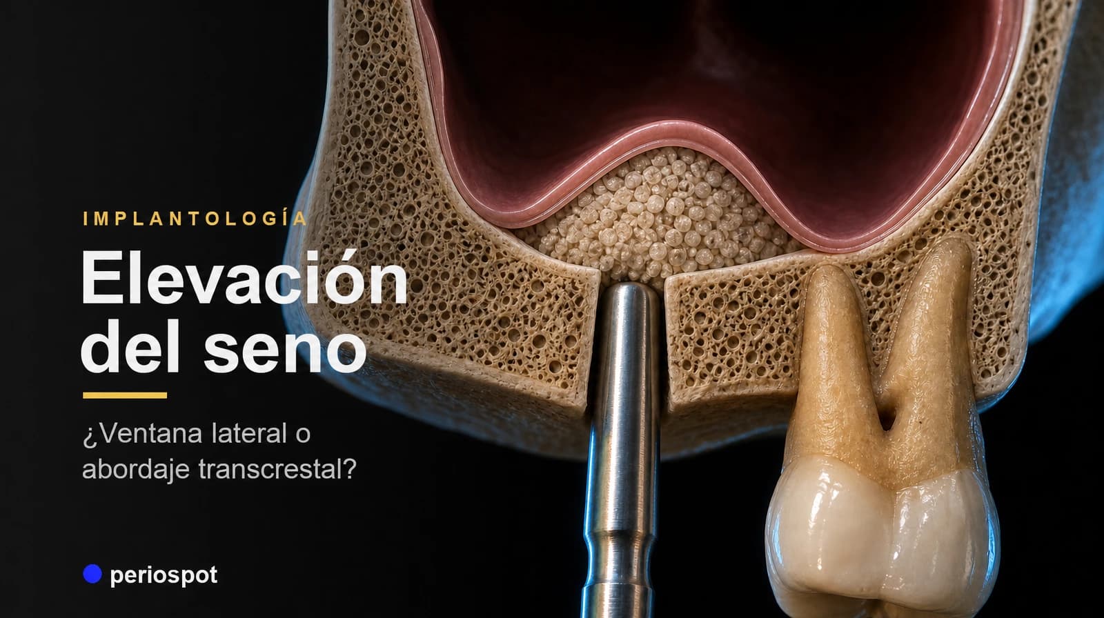 Elevación del seno maxilar en implantología: ¿ventana lateral o abordaje transcrestal?