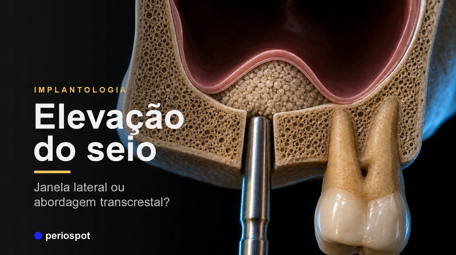 Elevação do seio maxilar em implantologia: janela lateral ou abordagem transcrestal?