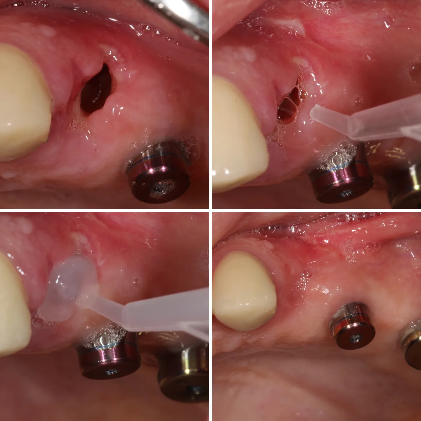 Four intraoral photos of one site: an open wound beside two implant healing abutments, the gel applied into and over the wound from a syringe, and the same site closed at a later visit.