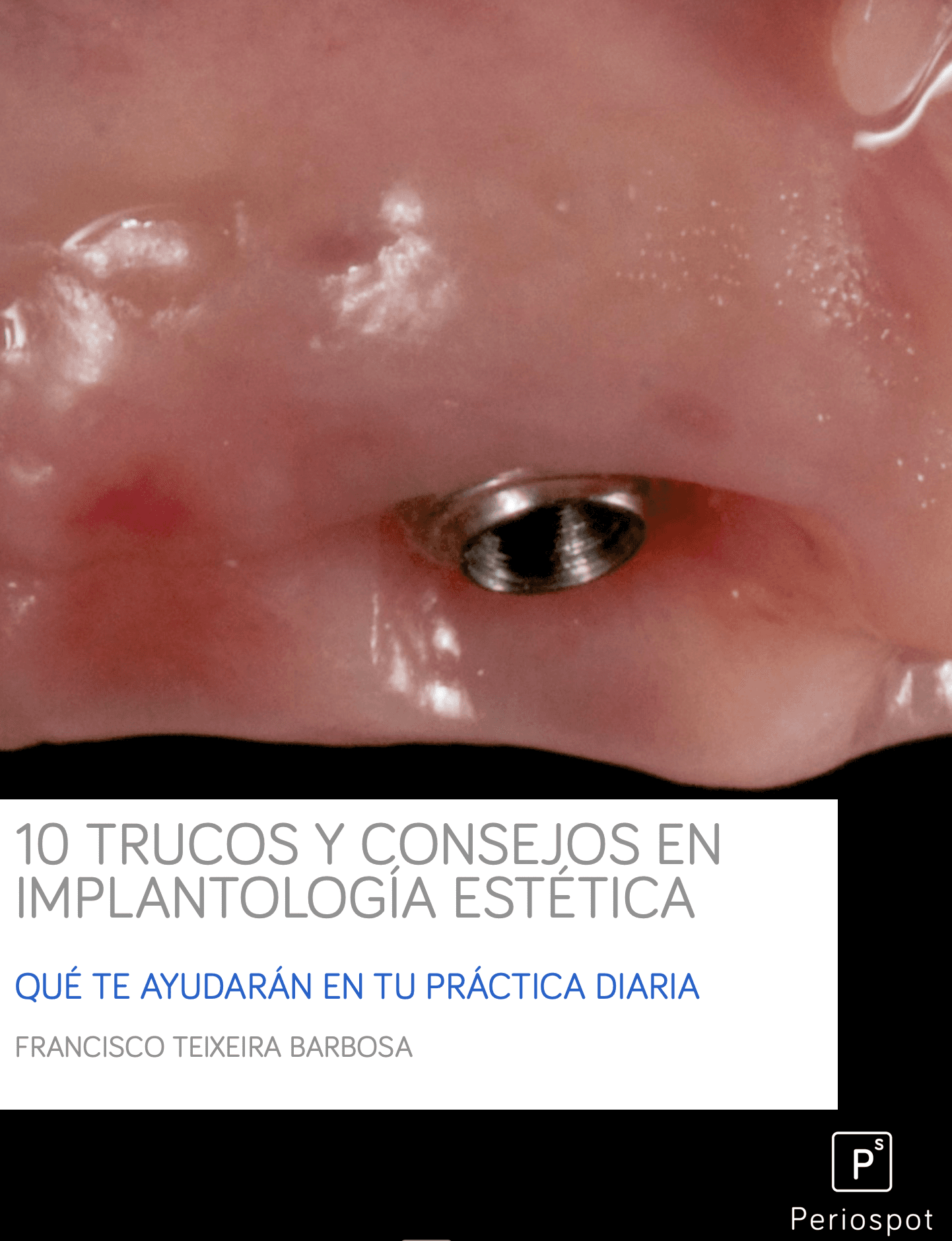 10 Consejos y Trucos en Implantología Estética