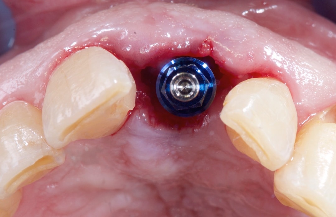 Occlusal clinical view of an implant with a cover screw in an anterior site planned for guided bone regeneration