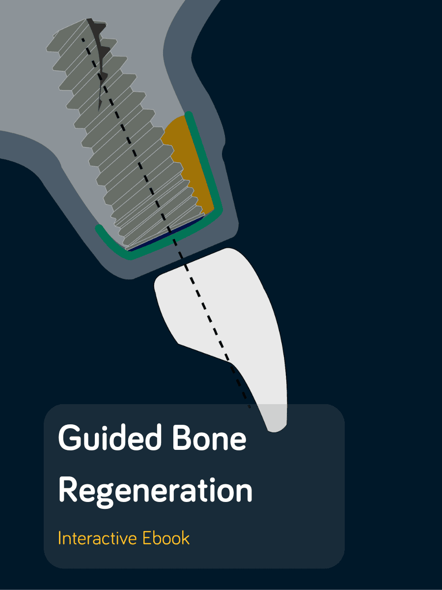 Guided Bone Regeneration