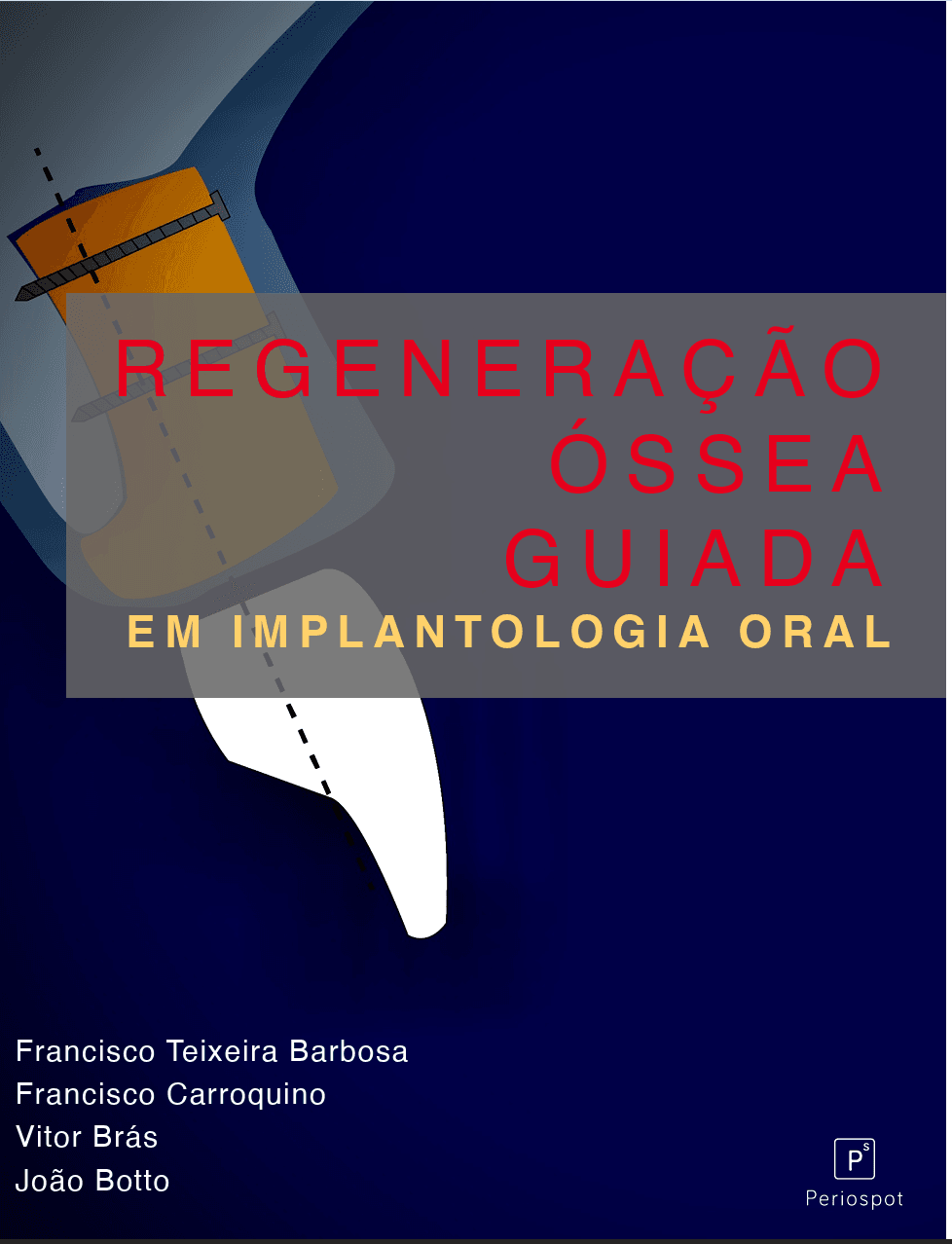 Regeneração Óssea Guiada em Implantologia Oral