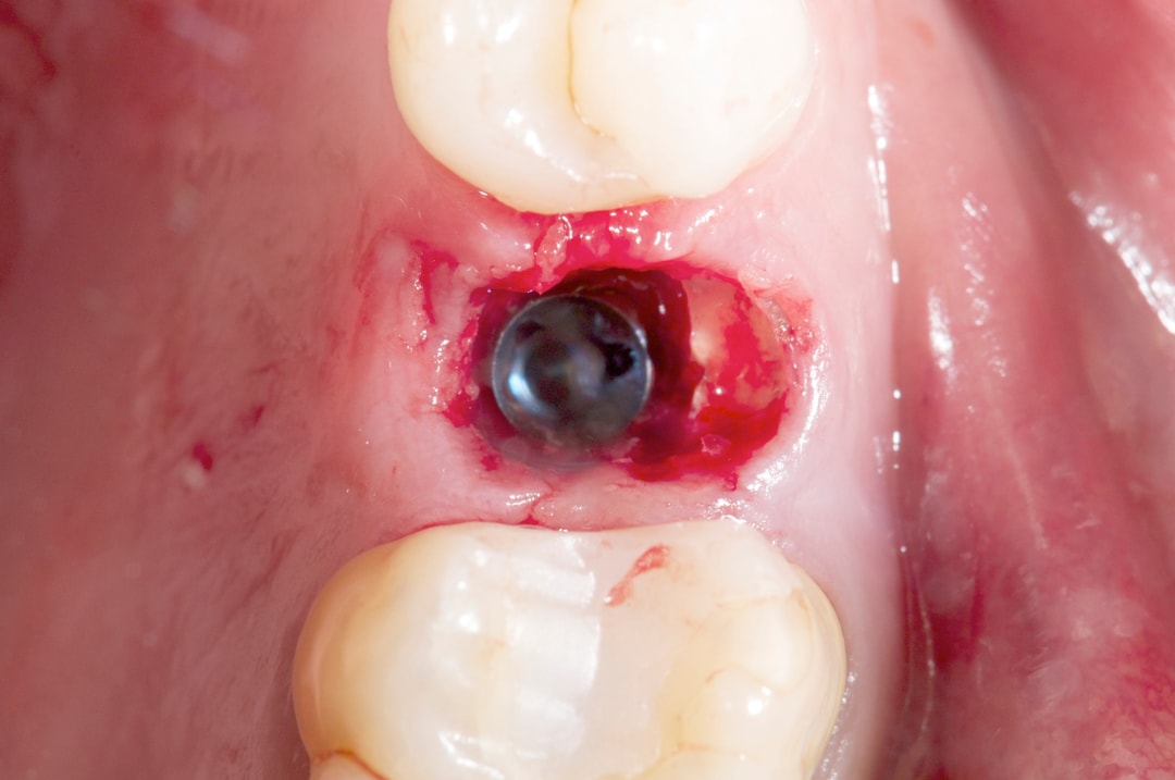 Clinical occlusal photo of a dental implant cover screw seated in a fresh extraction socket between two posterior teeth immediately after extraction
